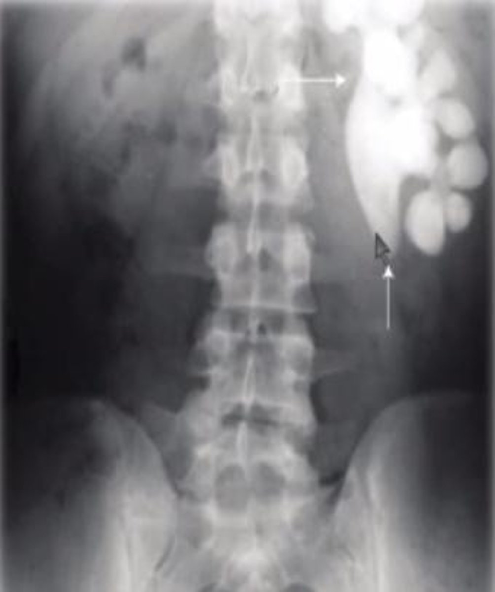 <p>(Magnesium ammonium phosphate)</p><p>- Occur in people with alkaline urine -&gt; a result of UTIs </p><p>Especially by bacteria that produce urease (Staph.)</p><p>- Struvite stones can make a cast of the renal pelvis -&gt; staghorn calculi </p>