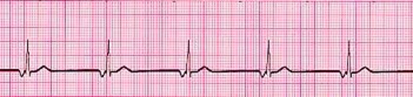 <p>40-60 Regular!</p><p>-impulse from AV node w/ retro/antegrade transmission</p><p>- P wave often inverted/buried/follow QRS</p><p>- slow rate</p><p>- narrow QRS (not wide like ventricular)</p>