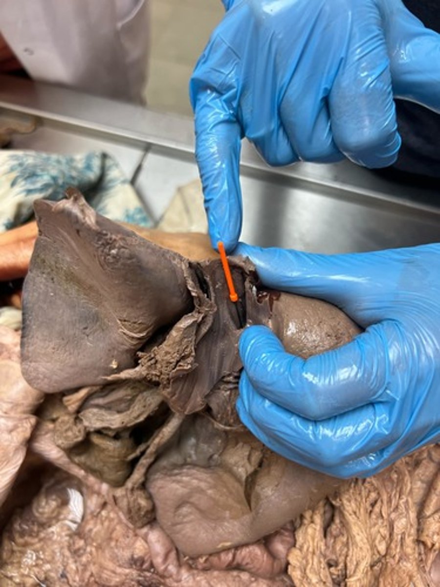 <p>l-r hepatic vain</p>