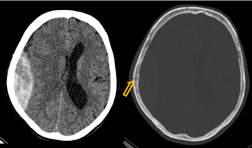 <p>Patient history: loss of consciousness following a bike accident </p><p>Modality: Non-enhanced CT; left – brain window setting (window level: 40 HU; window width: 80 HU), right – bone window setting (window level: 600 HU; window width: 2800 HU) </p><p>Region : Brain, axial views </p><p>Radiologic: Lens-shaped hyperdense mass and a radiolucent line at identical position (yellow arrow); compressed right lateral ventricle and midline sign shift due to mass effect. </p><p>Diagnosis : right-sided epidural hematoma with skull vault fracture </p>