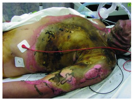 <p>Flame</p><p><em>Deep or full thickness</em></p>