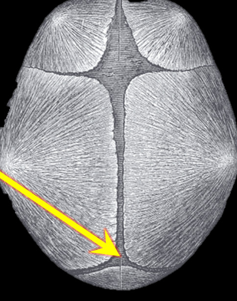<p>Posterior fontanel</p>