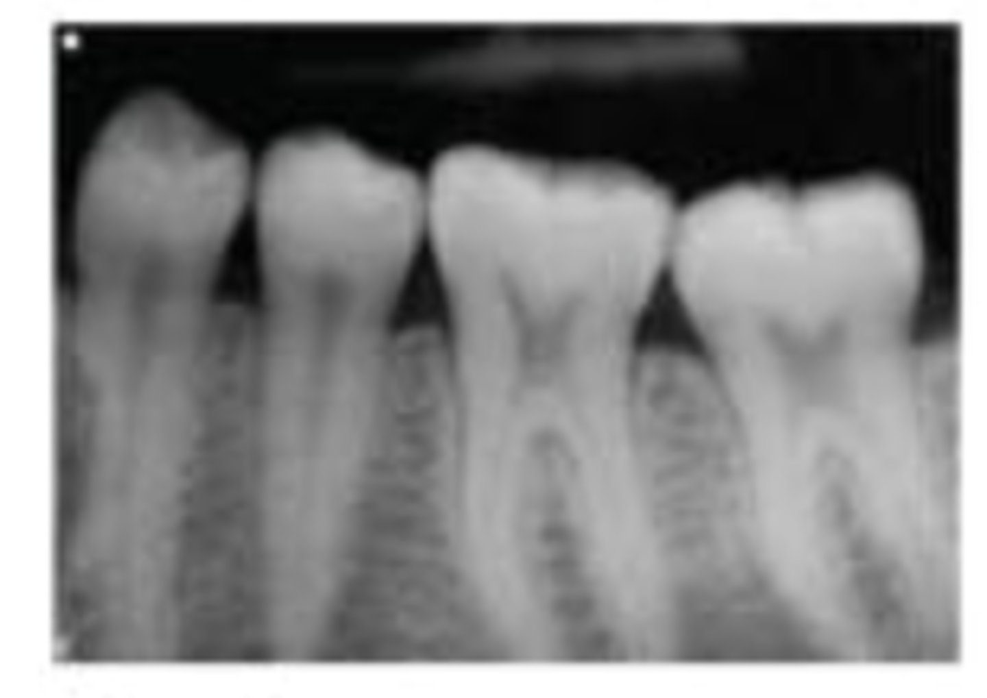 <p>the following radiographic error is caused by:</p><p>a. increased horizontal angulation</p><p>b. decreased horizontal angulation</p><p>c. increased vertical angulation</p><p>d. decreased vertical angulation</p>