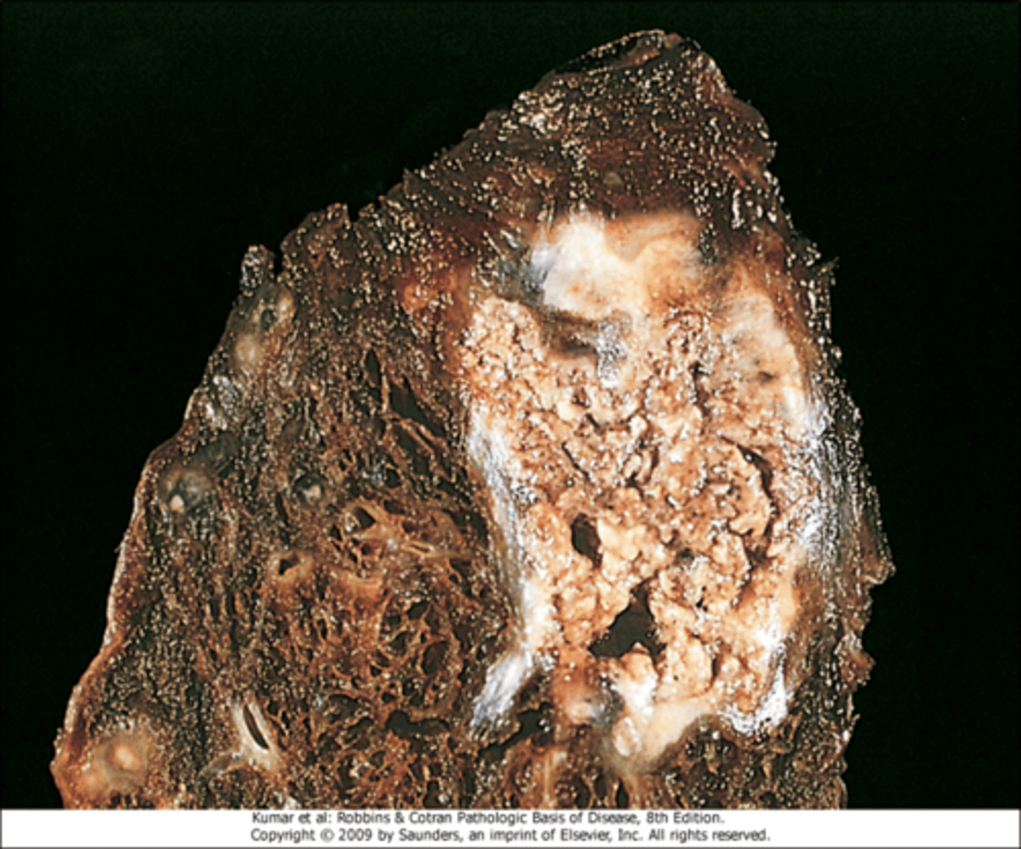 <p>Tuberculous cavity (lungs) seen in tuberculosis infections</p>