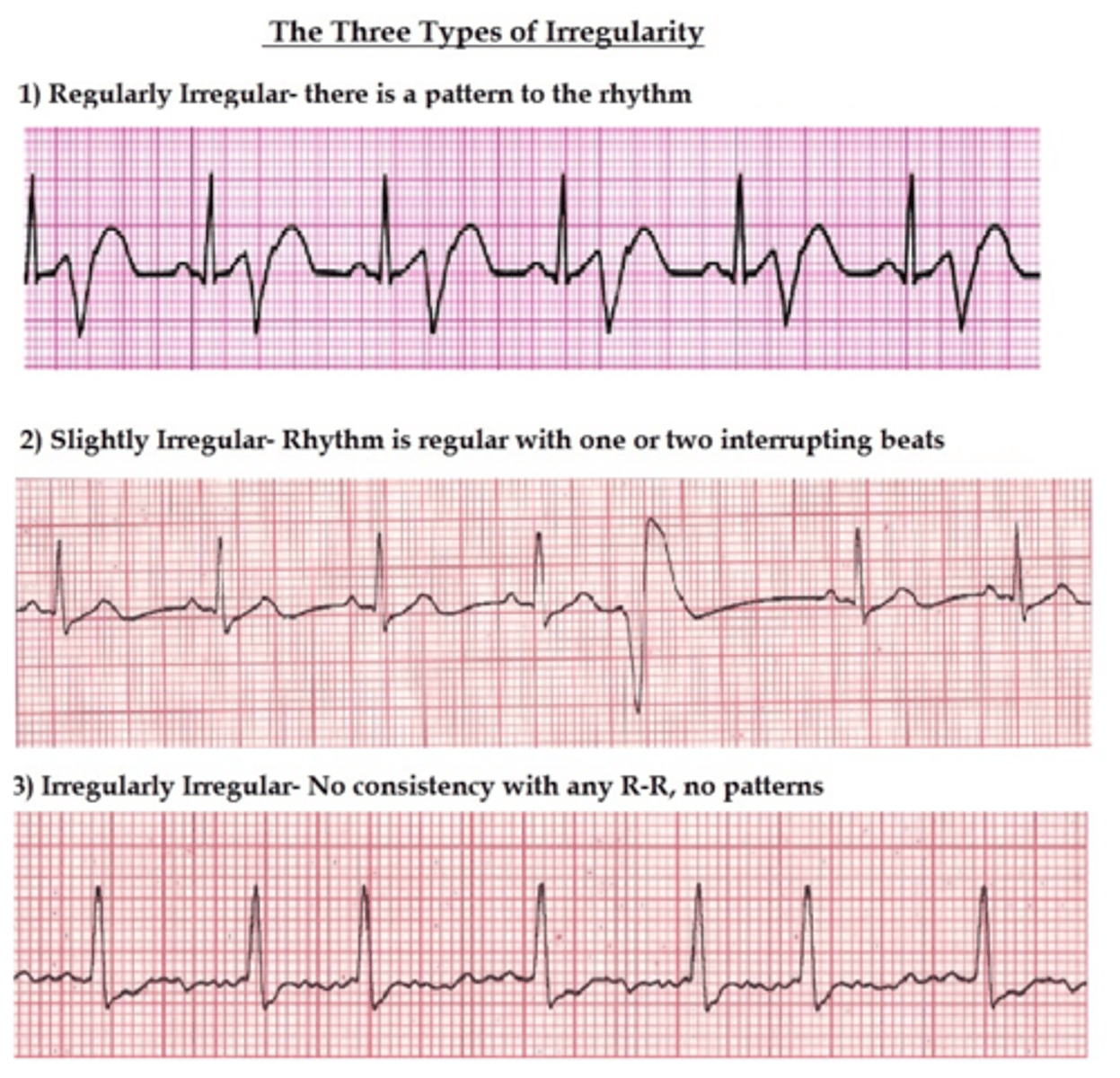 <p>regular, regularly irregular, irregularly irregular</p>