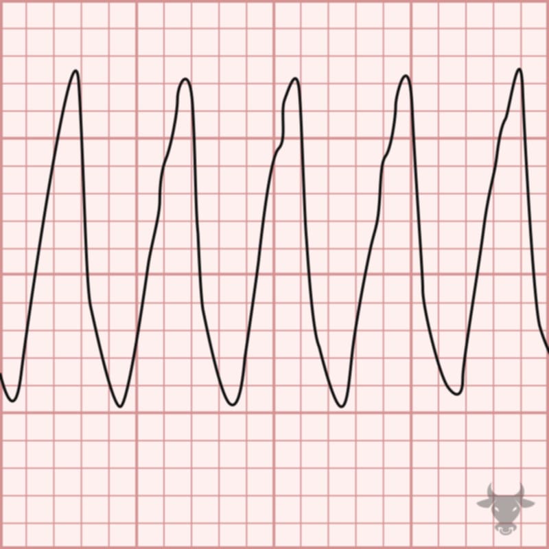<p>what rhythm is shown in the ECG?</p>