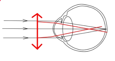 <p>image is now formed in front of the retina </p><p>distant objects become blurry </p><p>plus lenses in front of emmetropes simulate myopia as ligh already converging before they reach cornea </p>