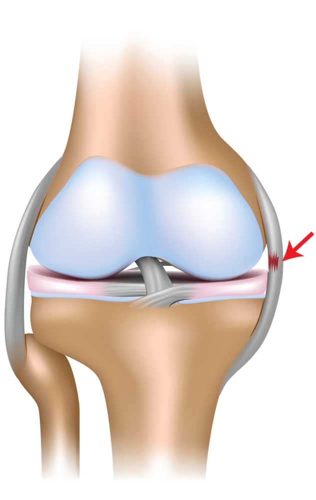 <p>most medial ligament of knee on the side</p>