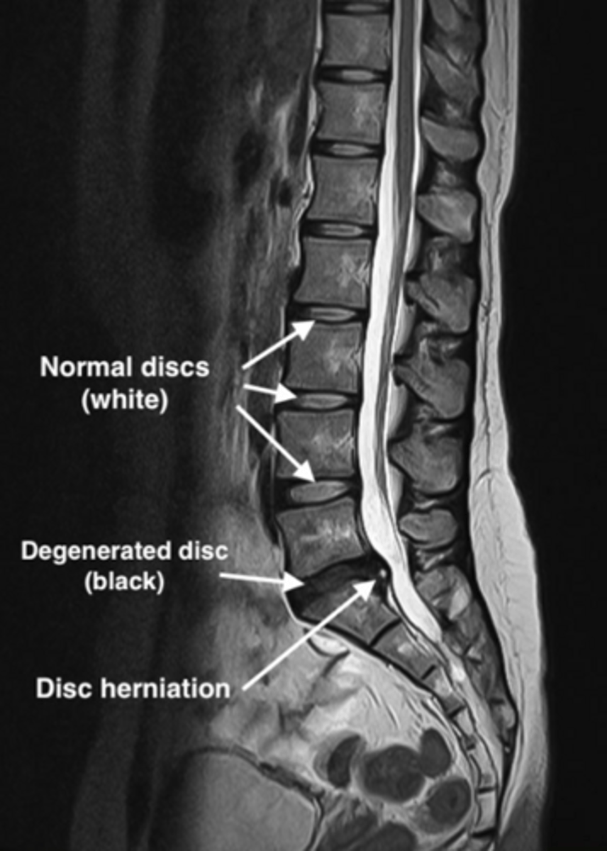 <p>MRI</p><p>•Highly sensitive and specific</p><p>•Red Flags = MRI ASAP!</p>