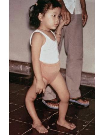 <p><span style="color: #ffffff">Paralysis of the muscles of the legs, abdomen, back,</span><span style="color: #ffffff"><br></span><span style="color: #ffffff">intercostals, diaphragm, pectoral girdle, and bladder can</span><span style="color: #ffffff"><br></span><span style="color: #ffffff">result, caused by infection of the brainstem, medulla and or cranial nerve, leads to muscle atrophy and limb deformaties</span></p>