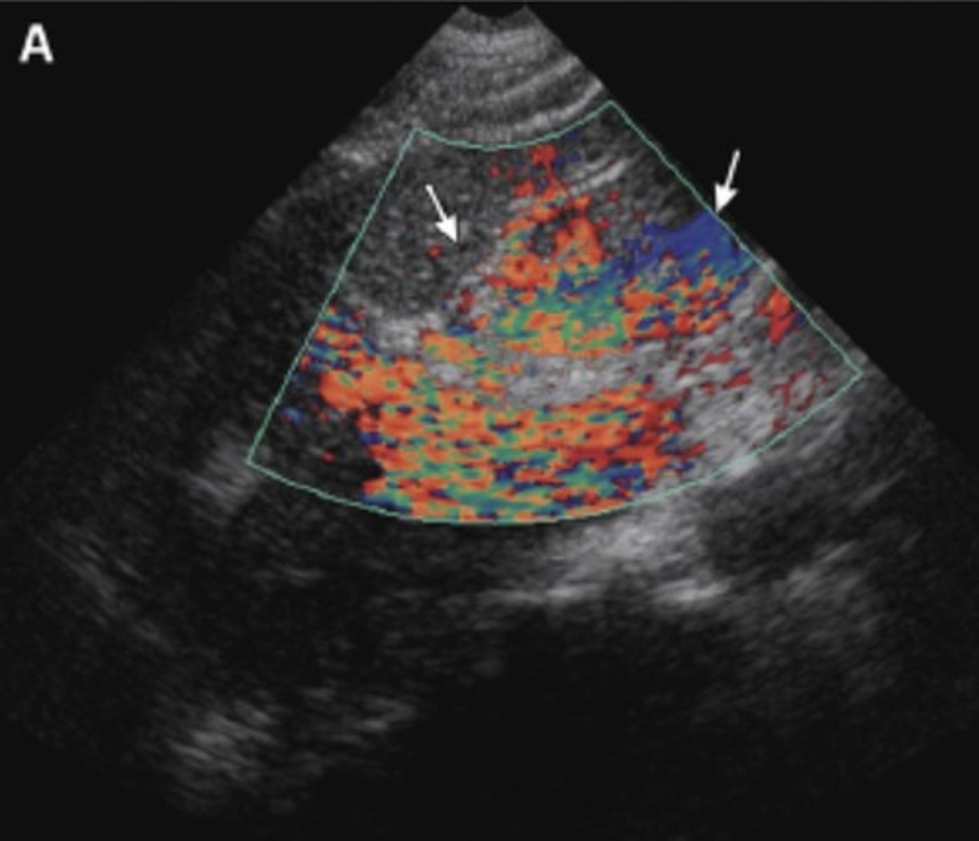 <p>Speckles/flashes of color appear for patient or transducer movements</p><p>Also present with bruits/high velocity flows</p>