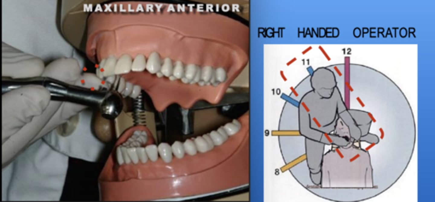 <p>Zone: 11</p><p>Vision: Direct or Indirect</p><p>Patient's Head: Center</p><p>Fulcrum: Max Right Premolars (O)</p>