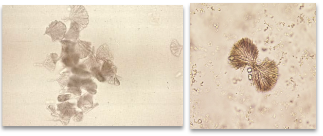 <ul><li><p class=""><strong>Appearance</strong>: Brown crystals seen as spheroids, flat needles, or sheaves of small needles</p></li><li><p class=""><strong>Urine pH</strong>: Acid</p></li><li><p class=""><strong>Solubility</strong>: Acetone &amp; alkali</p></li><li><p class=""><strong>Cause</strong>: Seen in patients taking sulfonamide antibiotics</p></li><li><p class=""><strong>Associated</strong>: Risk of kidney stone formation, especially with dehydration</p></li><li><p class=""><strong>Clinical tip</strong>: Confirm via medical history</p><p></p></li></ul><p></p>