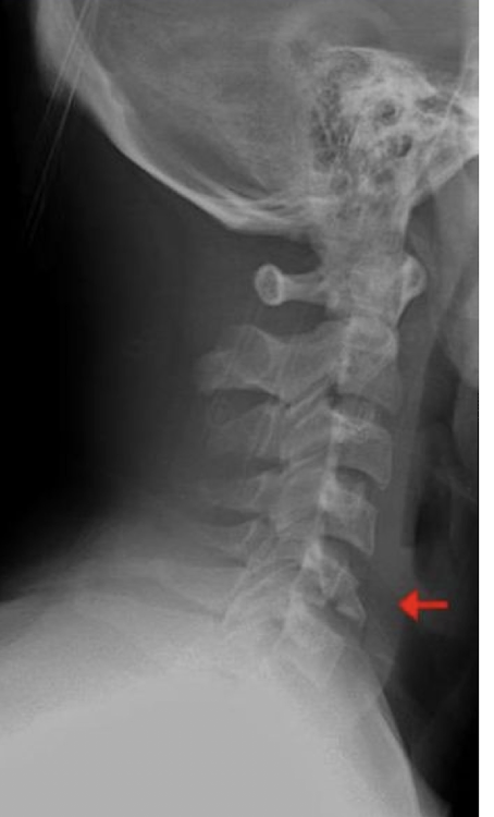 <ul><li><p>How:</p><ul><li><p>Axially loaded Intervertebral Disc compressed through the adjacent vertebrae</p></li><li><p>Bursting of the vertebrae w comminution </p></li></ul></li><li><p>Possibly Unstable </p></li></ul><p></p>