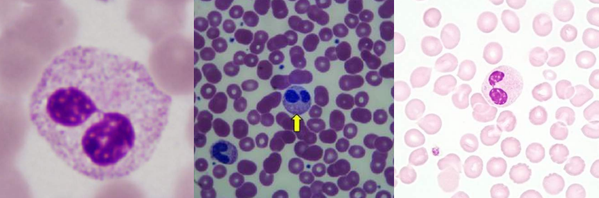 <p>A. Hyposegmented Neutrophils</p><p>B. Pelger-Huet Anomaly</p>