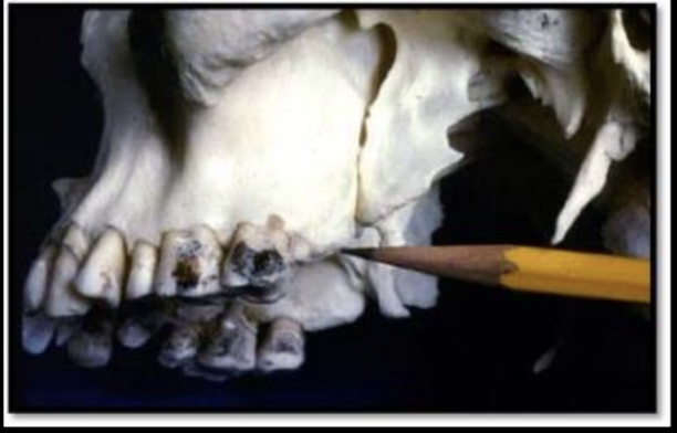 <p>Tuberosity: Rounded projection of bone </p>