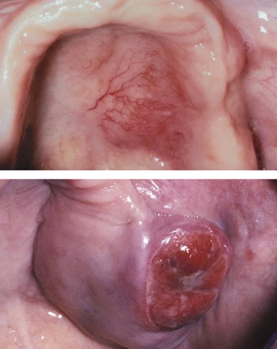 <p>Palatal swelling</p>