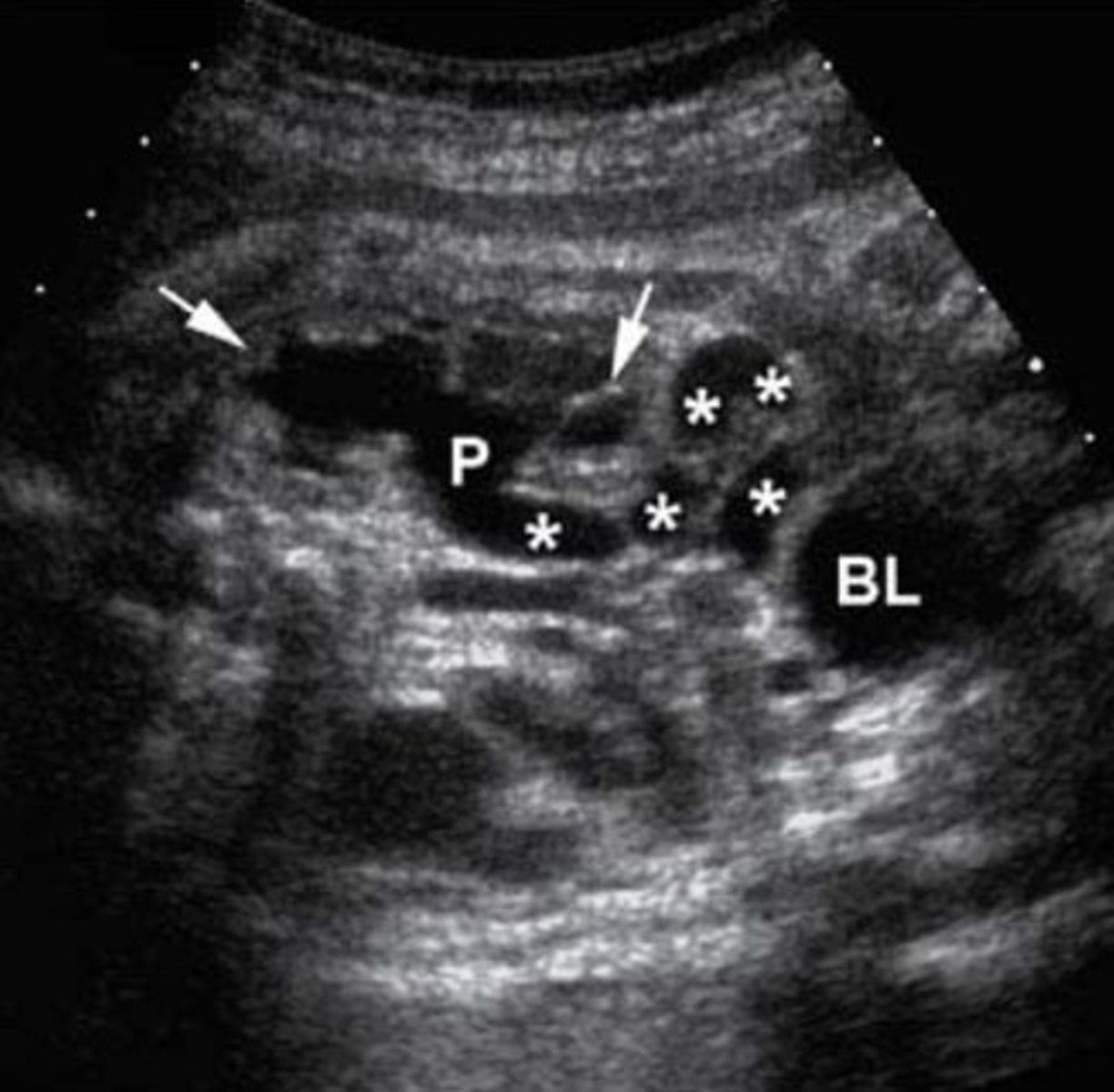 <p>Cortex is replaced with cysts</p><p>Dilated pelvis and ureter</p>