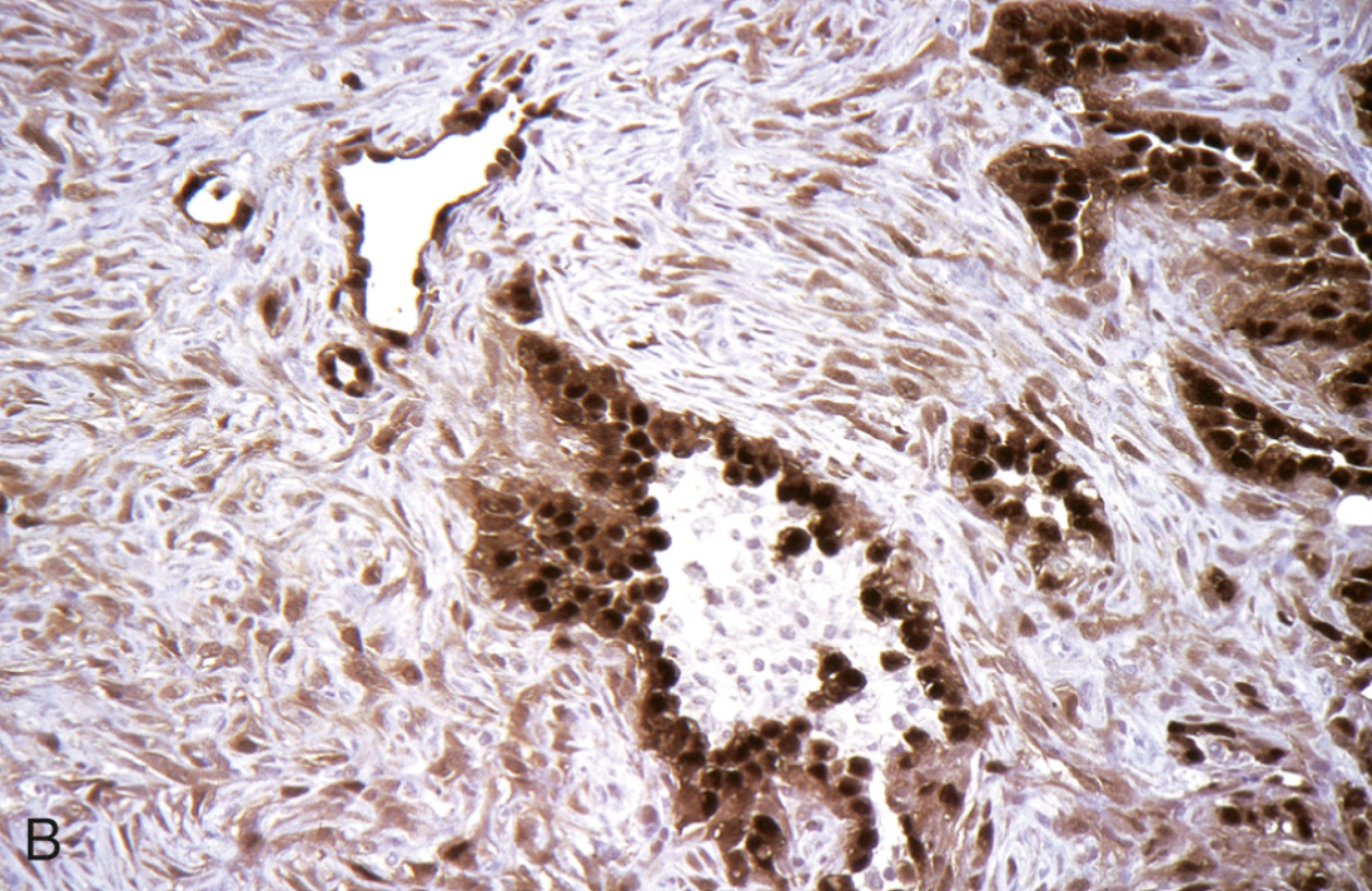 <p>Mesotelomia mixto, qué son las células oscuras</p>
