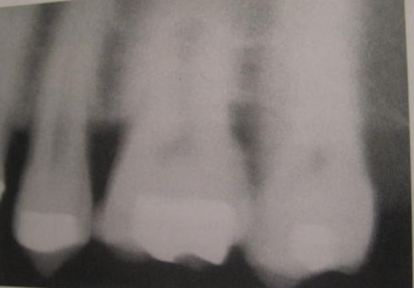 <p>movement of tubehead, receptor, or patient</p><p>stabilize patients head with headrest and instruct to keep still</p>