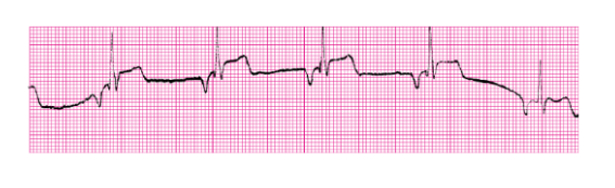 <p>What is the rhythm of Junctional rhythm?</p>
