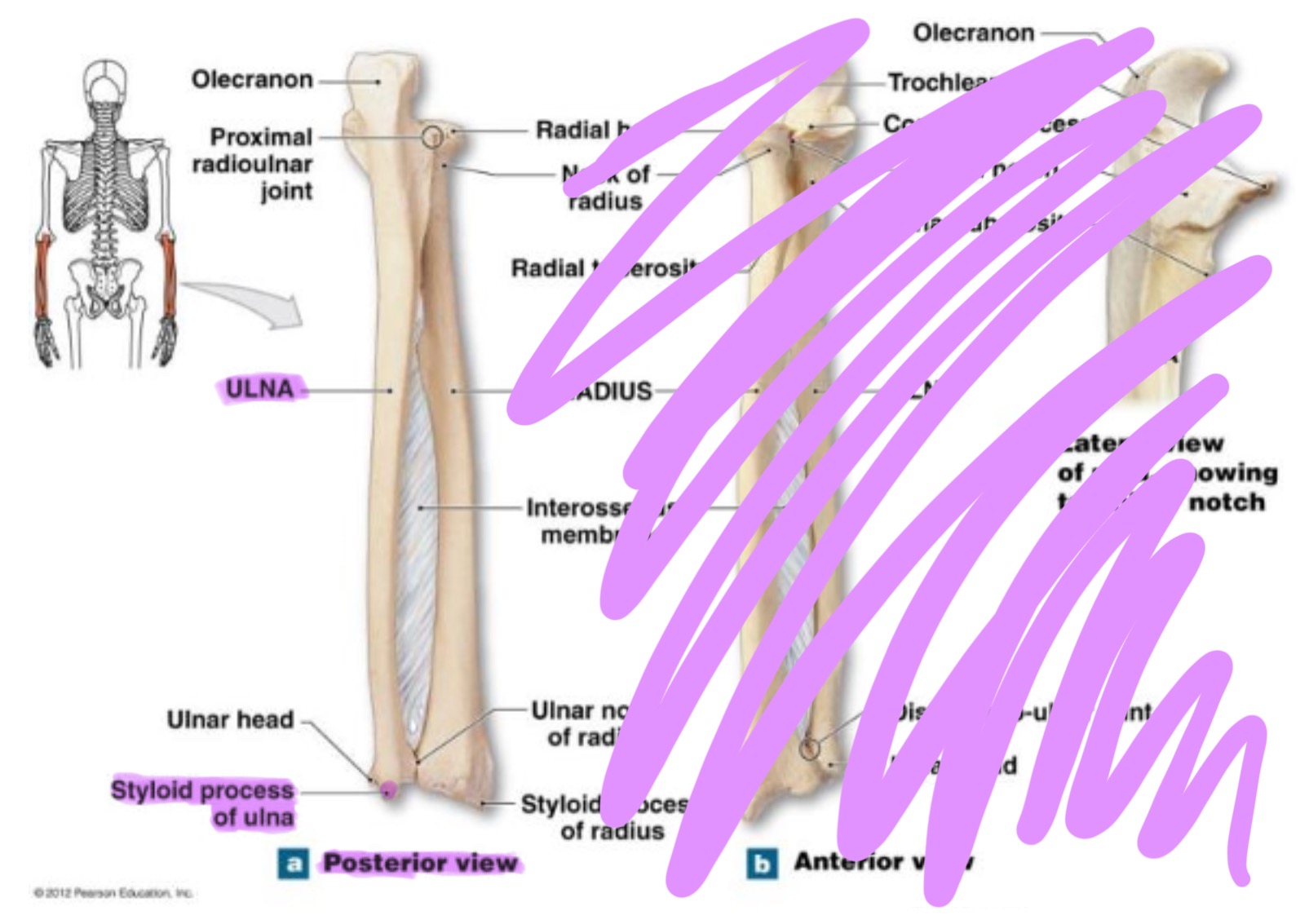 <p>pointed projection on the distal end of ulna; provides attachment for ligaments of wrist & helps stabilize ulnocarpal joint</p>