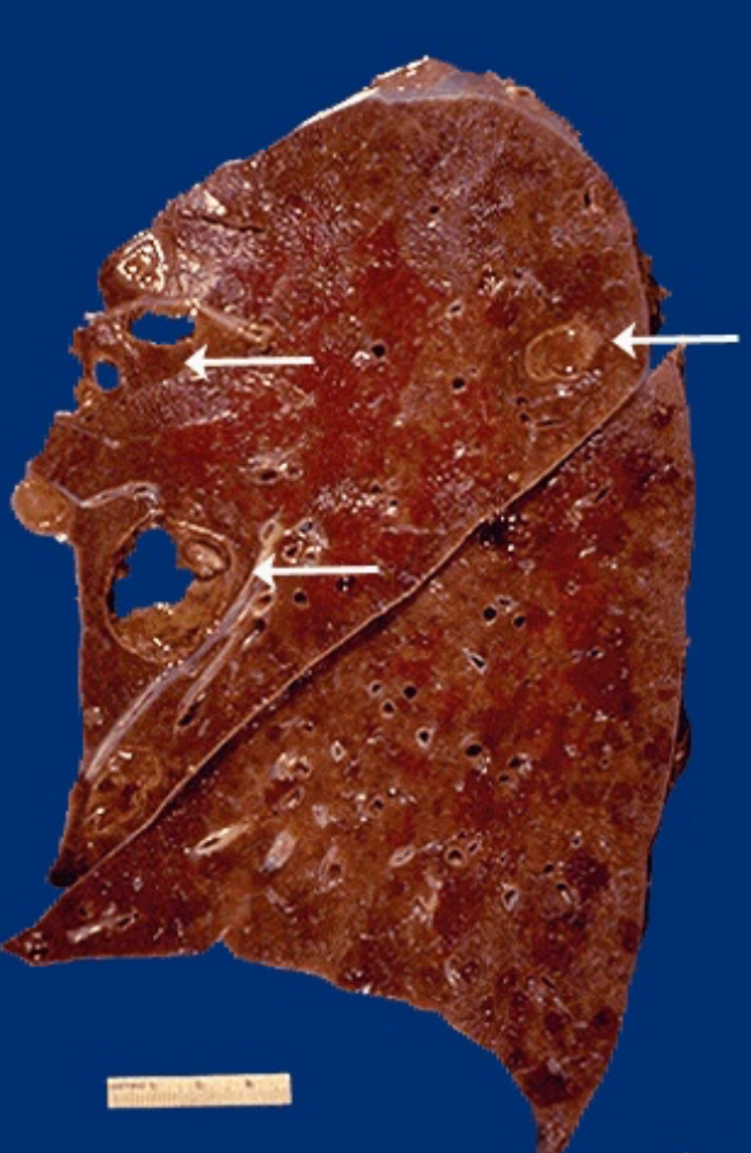 <ol><li><p>Liquefactive necrosis</p></li></ol><p></p><p><span>The liquefactive necrosis of an abscess is apparent, because the purulent contents are draining out to leave a cavity. On a chest radiograph, the liquefied central contents of an abscess can appear as an "air-fluid level".</span></p><p></p>