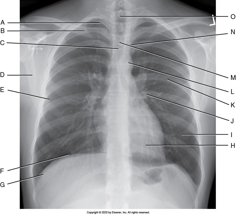 <p>Identify the labeled anatomy " G" on the PA chest projection</p><p>Scapula</p><p></p><p>Clavicle</p><p>&nbsp;</p><p>Lung apex</p><p>&nbsp;</p><p>Costrophenic angle</p>