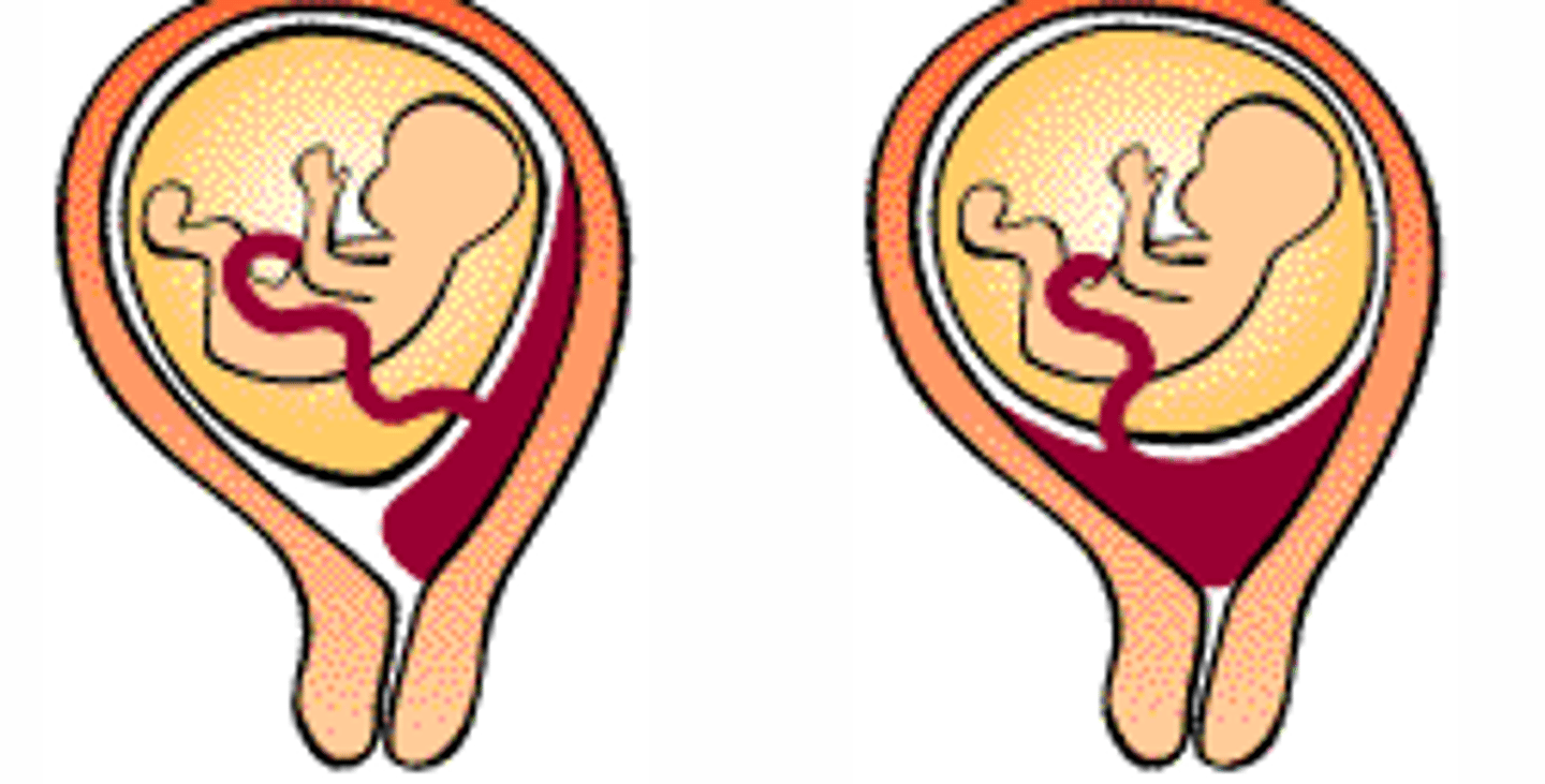 <p>When placenta implants close to the cervical os, even obstructing the cervical os.</p><p>- Is dangerous, as fetus will compress the placenta when delivered vaginally</p><p>= Will deprive the fetus of blood during delivery</p>