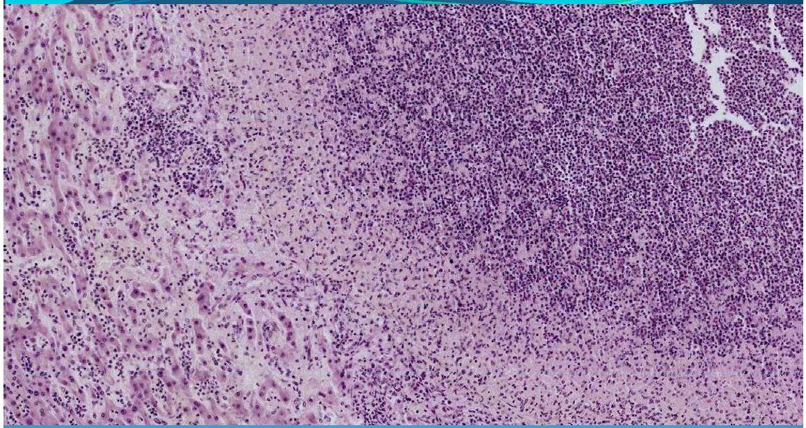 <p>LIVER:</p><p>Hepatic abscess; well circumscribed area of liquefaction necrosis + PMNs; pyogenic capsule</p>