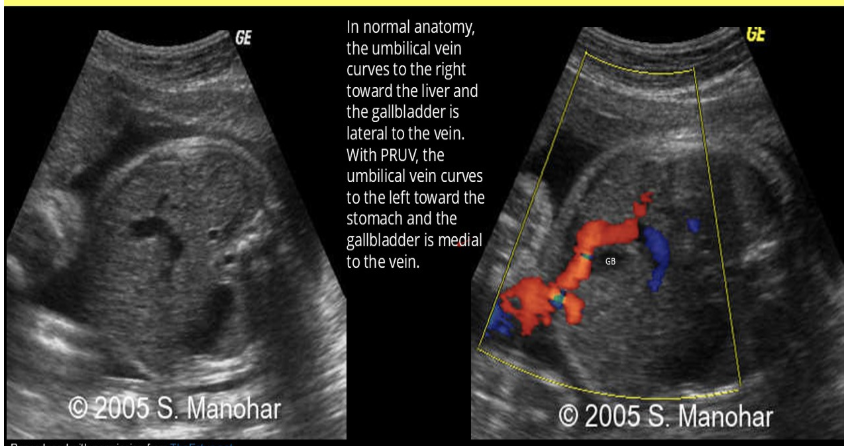 <p>when evaluating the AC of a 30w fetus, you see the umbilical vein curves to the left to the stomach + GB is medial to vein. AC + skin thickness measurements are normal</p><p>a) persistent right umbilical vein</p><p>b) absent ductus venosus</p><p>c) situs inversus</p><p>d) normal anatomy </p>