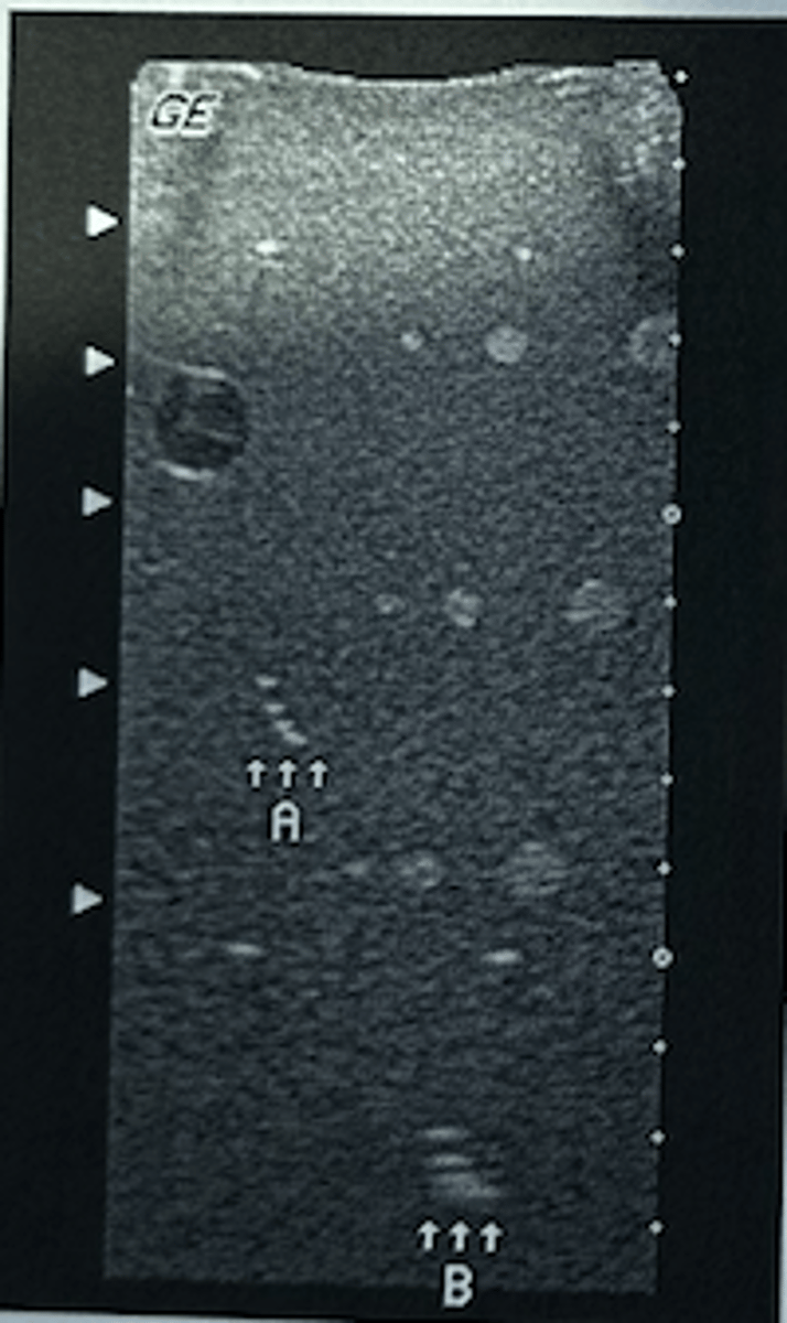 <p>What conclusion can be reached by comparing the rods labeled A and B in this phantom image?</p><p>A. Lateral resolution has deteriorated with depth.</p><p>B. Elevational resolution has deteriorated with depth.</p><p>C. Lateral resolution is best with the rods labeled B.</p><p>D. Axial resolution is best with the rods labeled B.</p><p>E. System sensitivity prohibits comparisons between the sets of rods.</p>