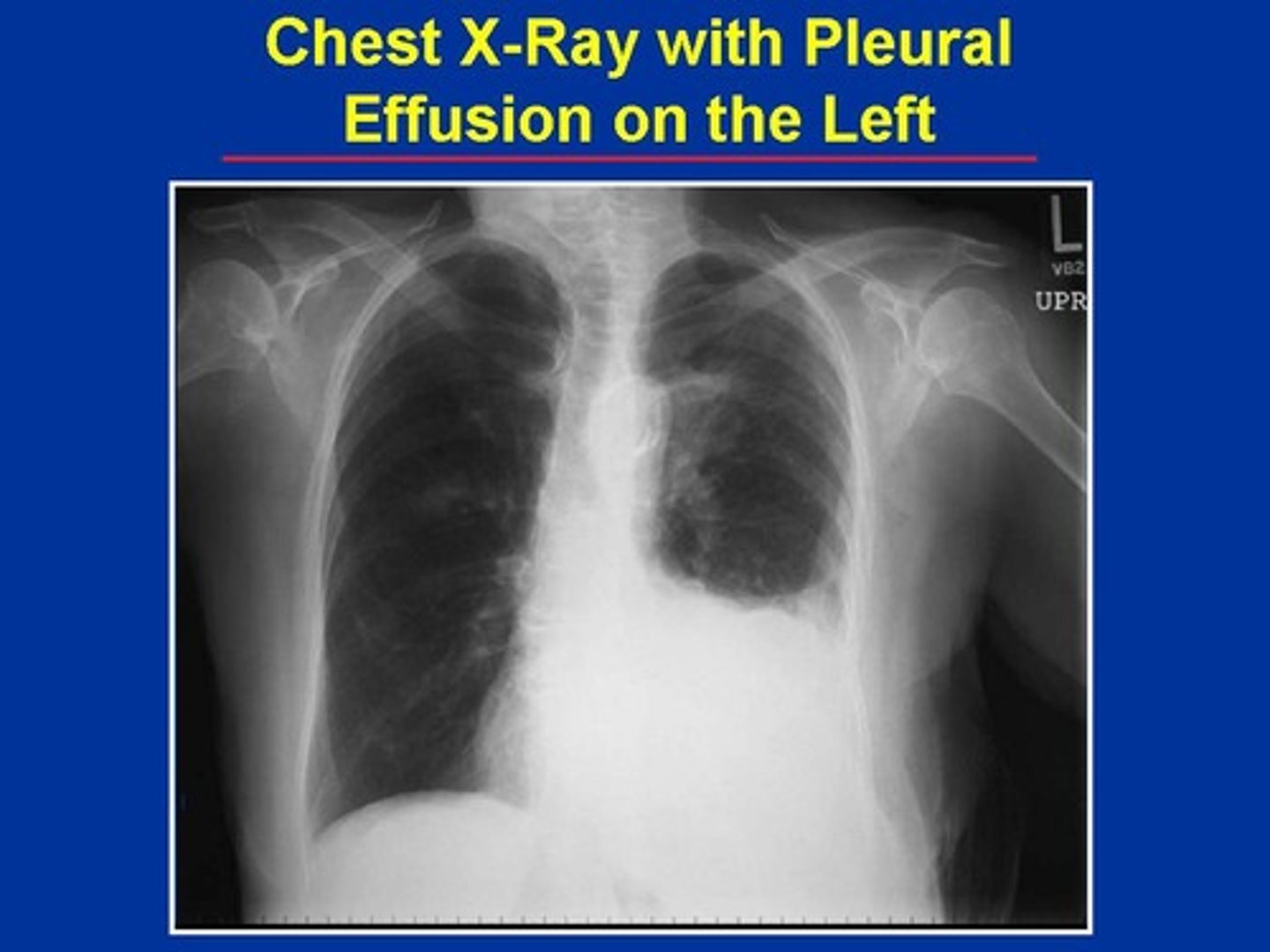 <p>-excess fluid (blood or pus) in the pleural cavity which can impair breathing</p><p>-may also see pleurisy which is inflammation of the pleural membranes</p><p>-this can compress the lungs!</p><p>-caused by an alteration in ventilation</p>