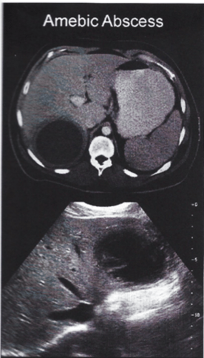 <p>Entamoeba hystolytica</p><p>- travel to Mexico, dysentery + RUQ pain with single cyst</p><p>- stool exam trophozoites, serology, liver imaging</p><p>- tx: Metronidazole</p>