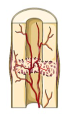 The fibrocartilage callus is gradually replaced by one made of spongy bone. This new mass is referred to as the bony callus. Osteoclasts and osteoblasts move to the area and multiply.