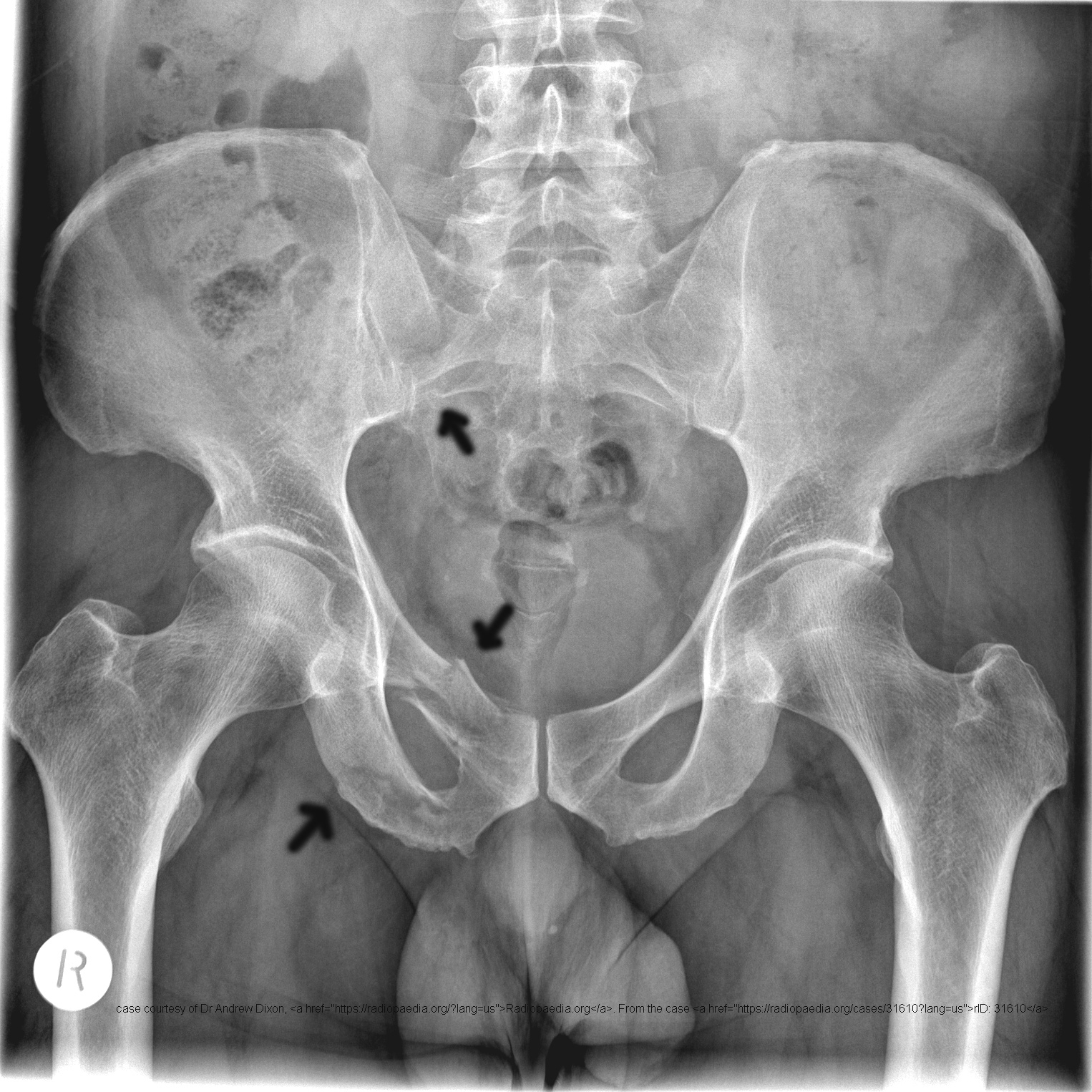 <p>They completely disrupt the pelvic floor, leading to severe internal bleeding.</p>