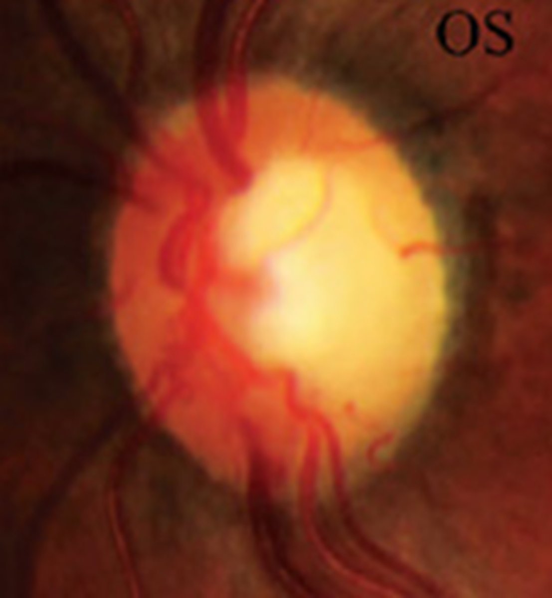 <p>toxic disease = alcohol, malnutrition</p><p>hereditary degeneration = Leber's optic atrophy, autosomal dominant optic atrophy, etc.</p><p>acute demyelinating disease</p><p>compressive disease</p>