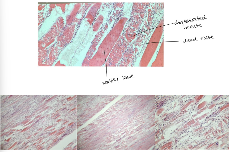 <p>Dystrophia musculorum </p>