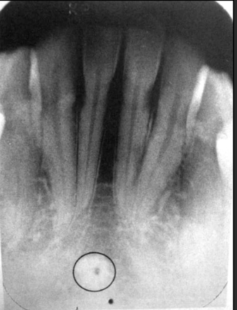 <p>Presents as a ring shaped radio opacity (white donut). Sits below the centrals on the mandible. It is the white portion. The radiolucent dot is a different structure</p>