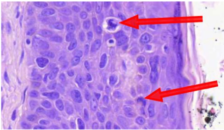 <p>mihin viittaavat seuraavat mitoosit? (vinkki: aktiinikeratoosi)</p>