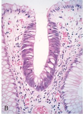 Low risk for development of carcinoma