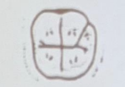 <p>When looking at a mandibular 1st molar, which of the following statements is FALSE</p><p>a. the crown is wider on the facial than on the lingual</p><p>b. the F-L dimension on the mesial is greater than the F-L on the distal</p><p>c. the crown is wider B-L then M-D</p>