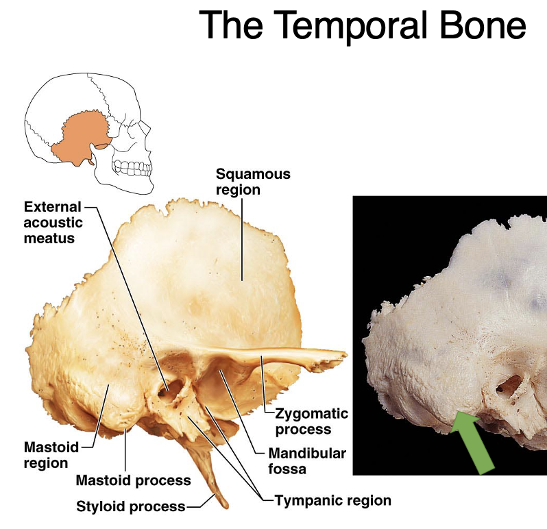 <p><span>Squamosal of temporal bone</span></p>