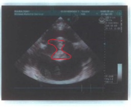 <p>What problem can be identified on this ocular ultrasound</p>