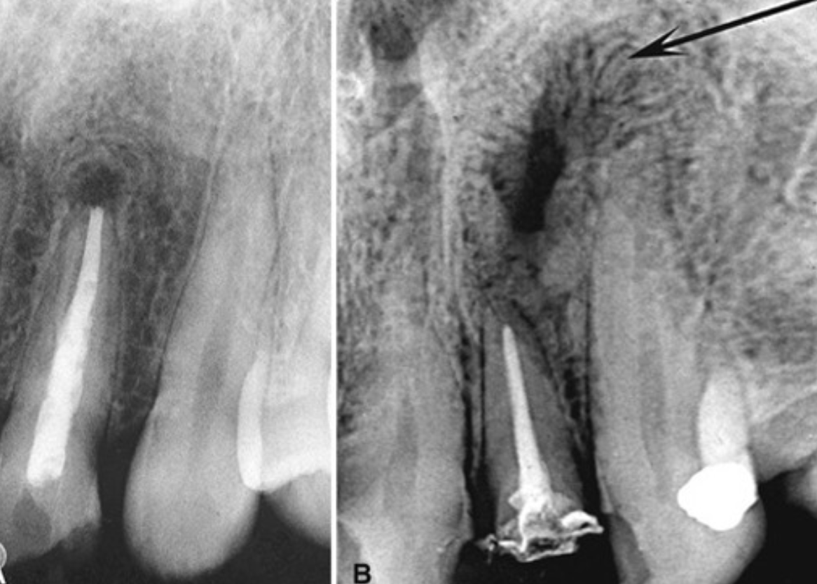 <p>radiolucent areas may persist after successful orthograde or retrograde endodontics</p><ul><li><p>central radiolucency may represent healing connective tissue</p></li><li><p>periophery may show granular bone or radiating trabeculae →&nbsp;“rolled border” or doughnut/fibrous scar pattern</p></li></ul><p></p>