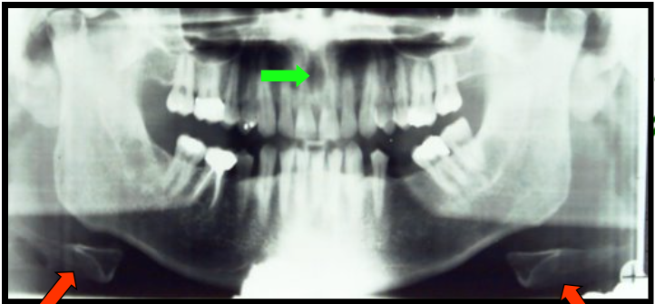 <ul><li><p><span>appears as a small, ovoid or round radiolucency located between the root of the maxillary central incisors.</span></p></li><li><p><span>appears as a “floating” curved radiopacity at or below the inferior border of the mandible.</span></p><ul><li><p><span>is at the midline and as a result, appears as a double image and is seen on both the right and left sides of the panoramic image.</span></p></li></ul></li></ul><p></p>