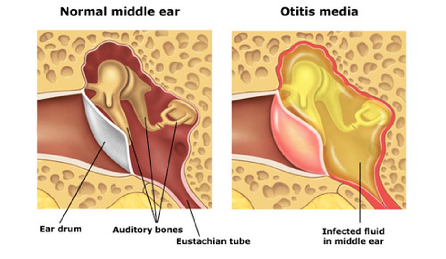 <p>infection of the middle ear space, causing conductive hearing loss</p><p>common in children as they have small auditory / eustachian tube so can get blocked easily if they have a cold</p>