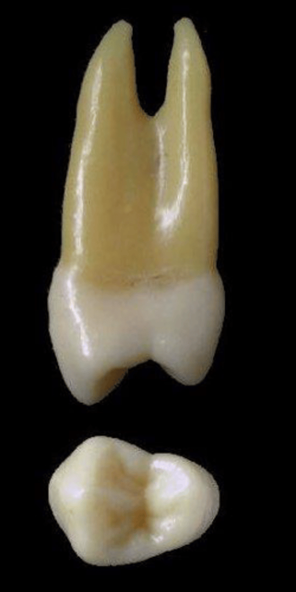 <p>what tooth is this &amp; why?</p>