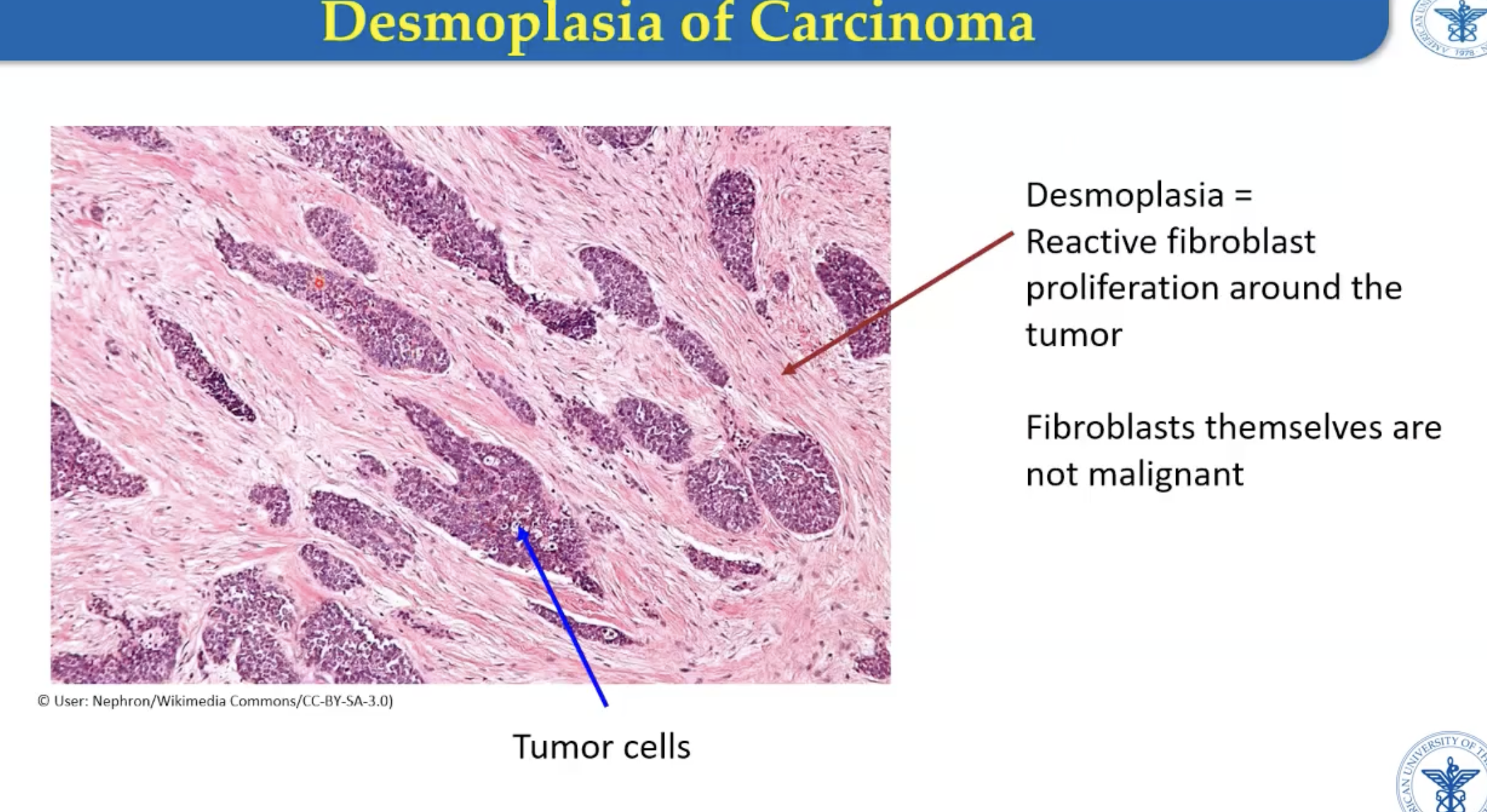 <p>Fibroblast reactive proliferation to create collagen (non-neoplastic)</p><ul><li><p>Fibroblasts themselves are not malignant</p></li></ul><p>On cut section, tumor fibrosis appears <strong>white/gray</strong></p><p>** Characteristic of carcinomas</p><p></p><p>Remember: not the same as capsules (which is a feature of benign tumors)</p>