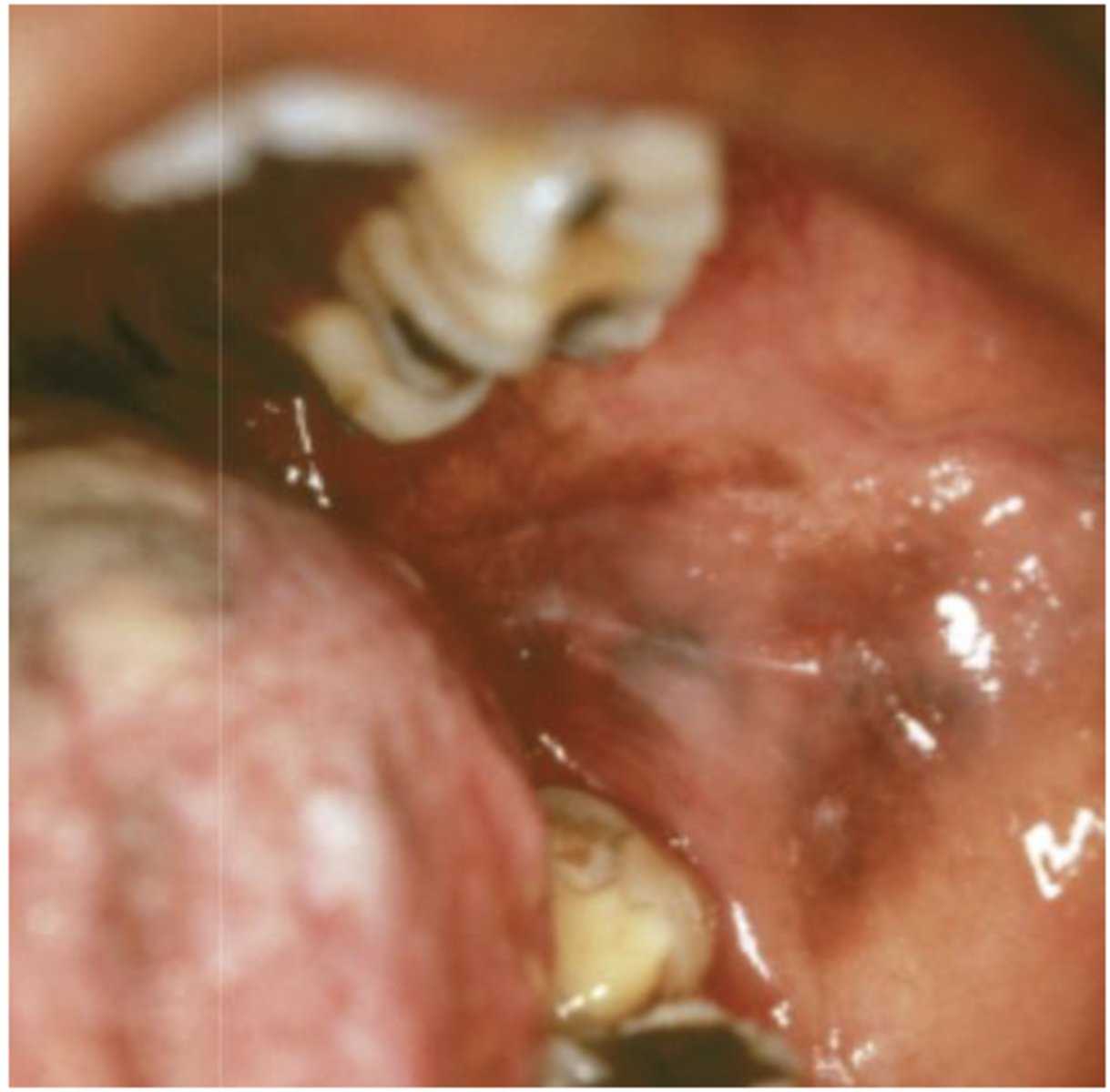 <p>What type of pigmented lesion?</p>